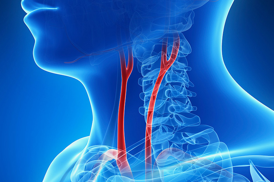 KAROTİS ARTER (ŞAH DAMARI) HASTALIKLARI TEDAVİSİ