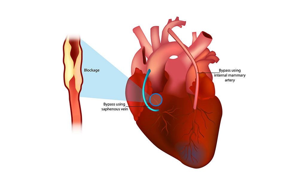 Çalışan Kalpte Koroner Bypassın avantajları nelerdir?